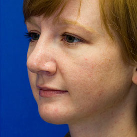 After bulbous tip rhinoplasty