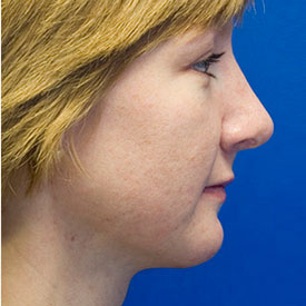 After pollybeak rhinoplasty