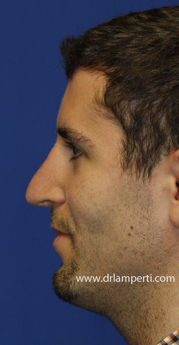 After Pinched Tip Revision Rhinoplasty