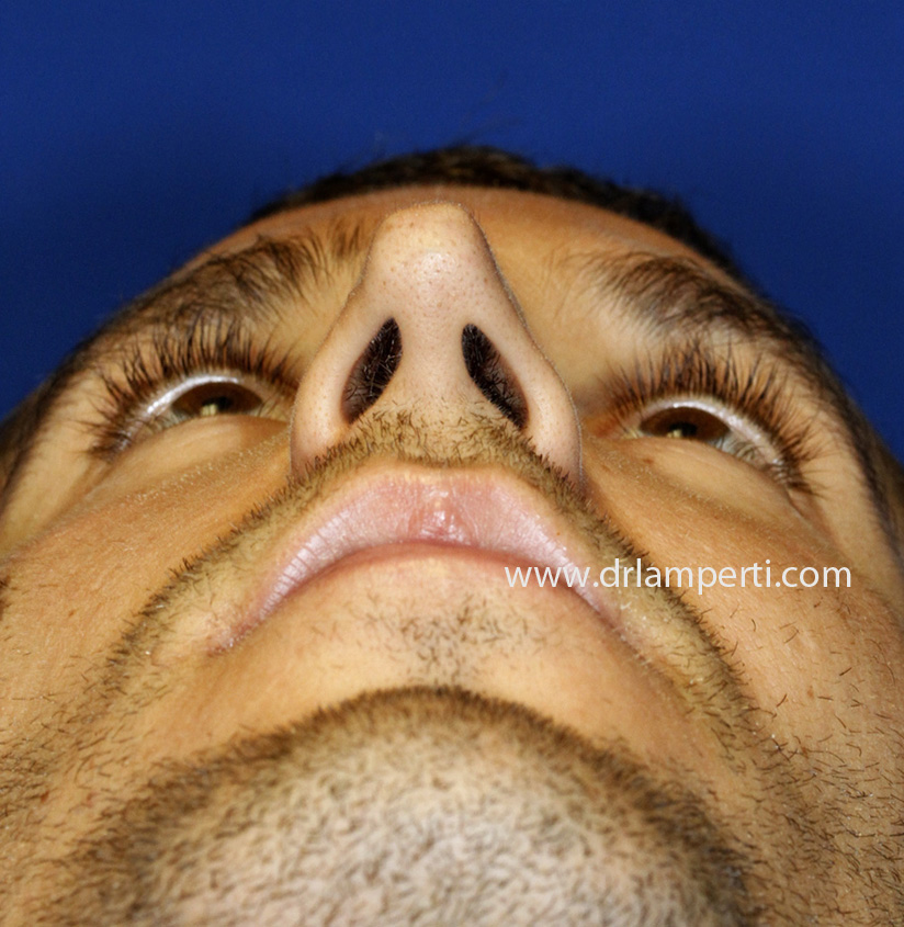 Before Pinched Tip Revision Rhinoplasty