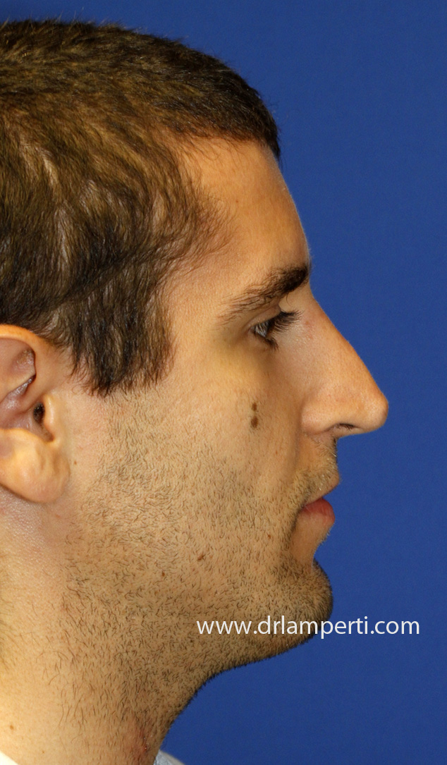 Before Pinched Tip Revision Rhinoplasty