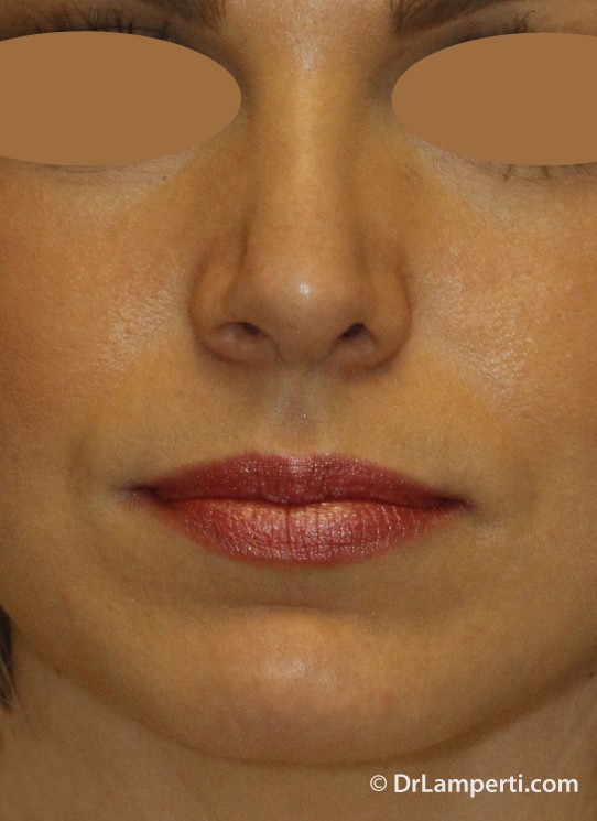 Revision rhinoplasty After Frontal