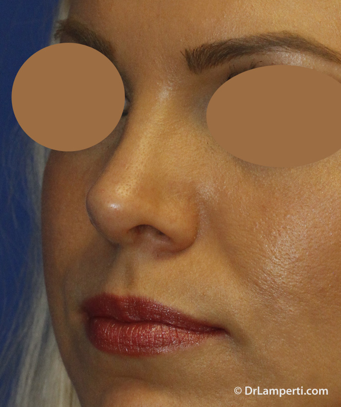 Revision rhinoplasty After L Oblique