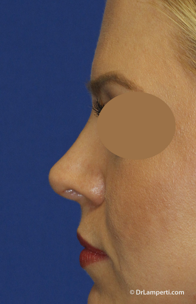 Revision rhinoplasty After Left Profile