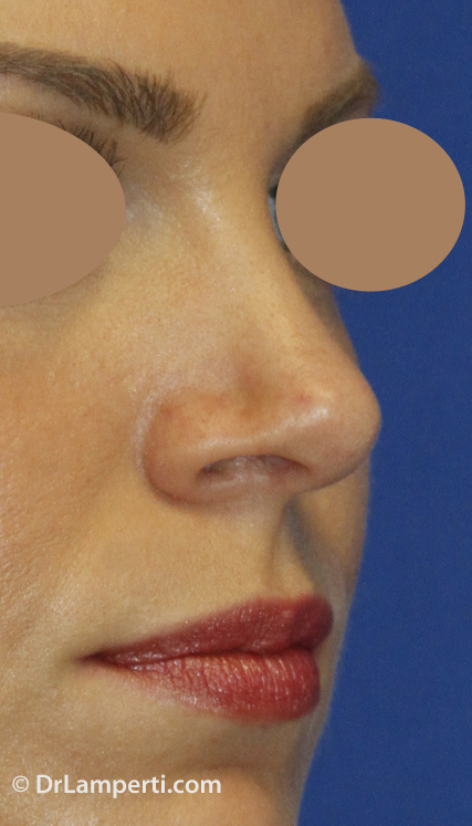 Revision rhinoplasty After R Oblique