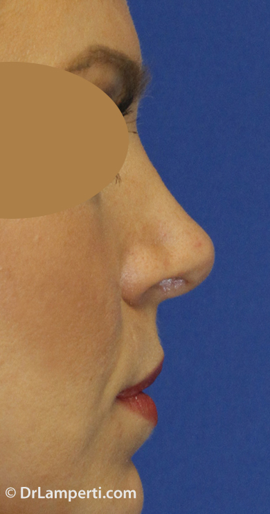 Revision rhinoplasty After Right Oblique