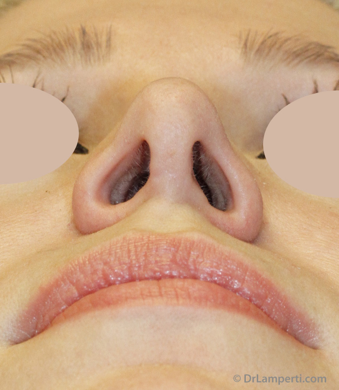 Revision rhinoplasty Before Base