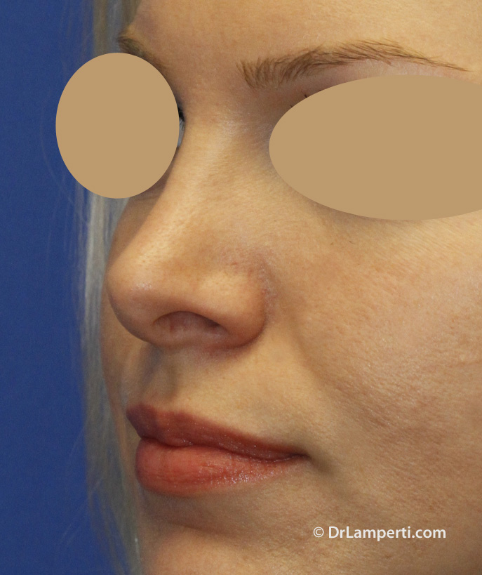 Revision rhinoplasty Before L Oblique