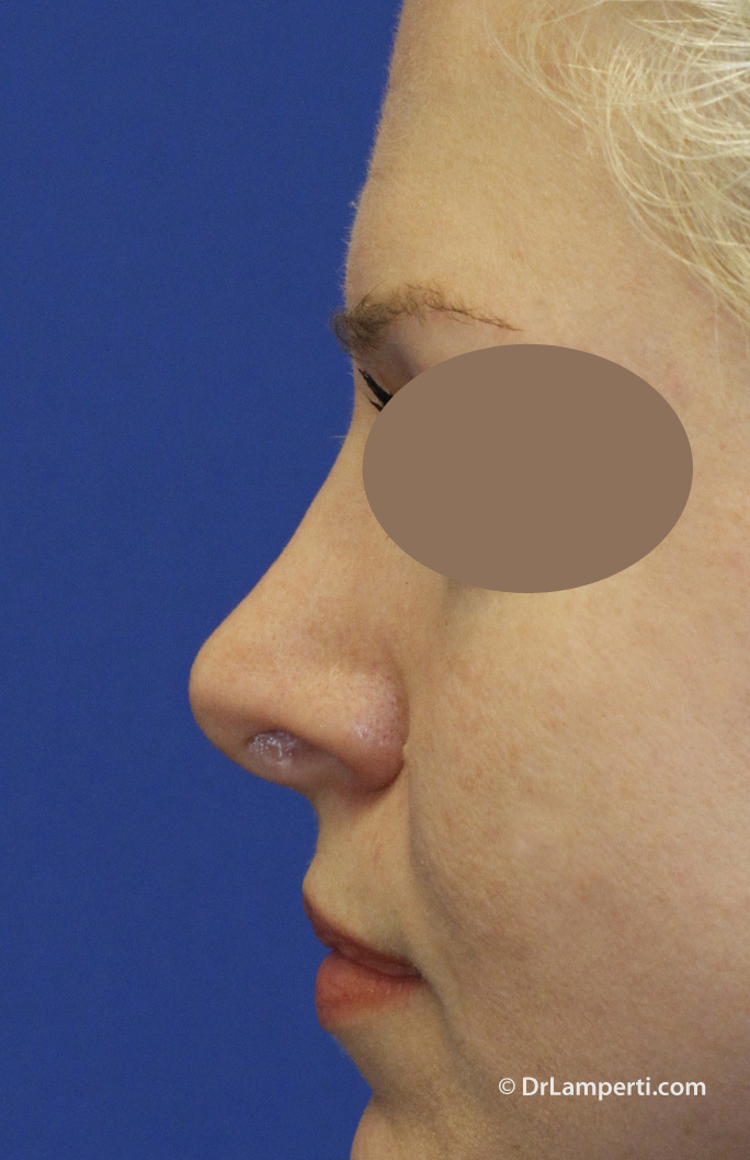 Revision rhinoplasty Before L Profile