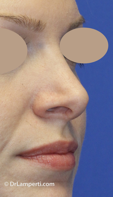 Revision rhinoplasty Before R Oblique