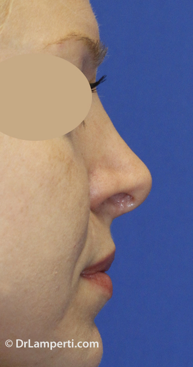 Revision rhinoplasty Before Right Profile