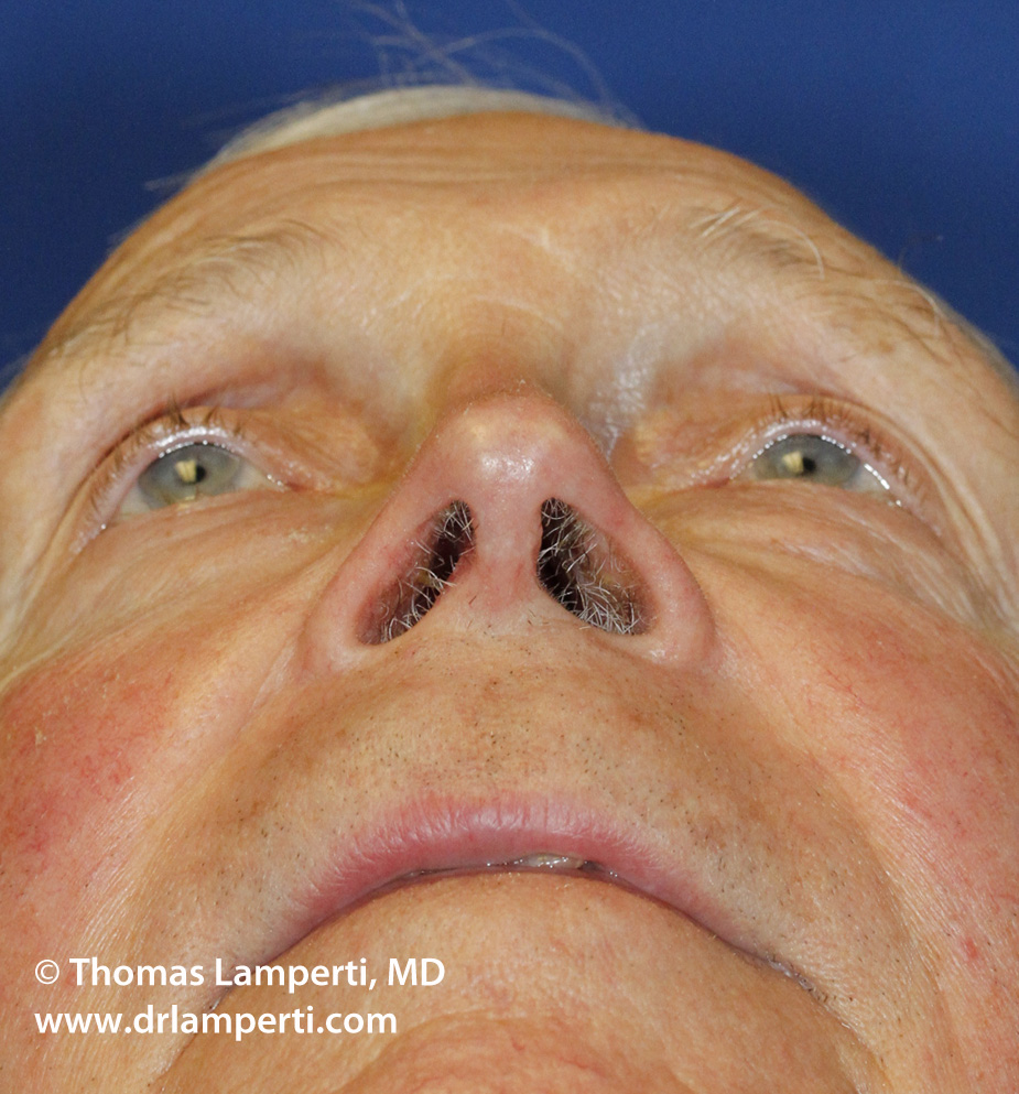 Base Revision Rhinoplasty After