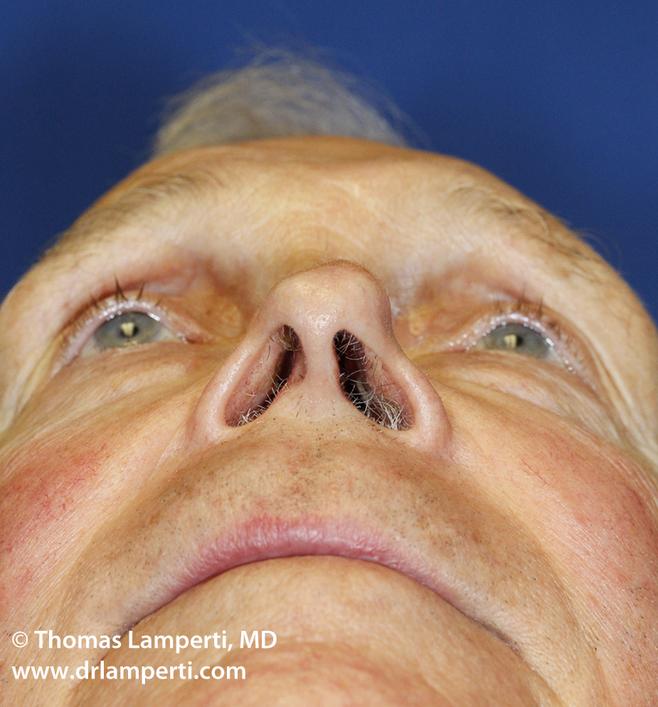 Base Revision Rhinoplasty Before