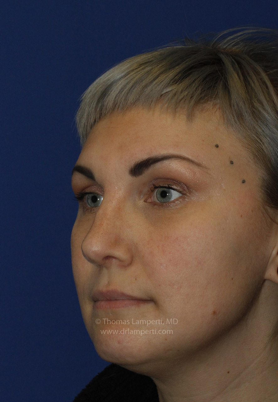 Rhinoplasty After L Oblique