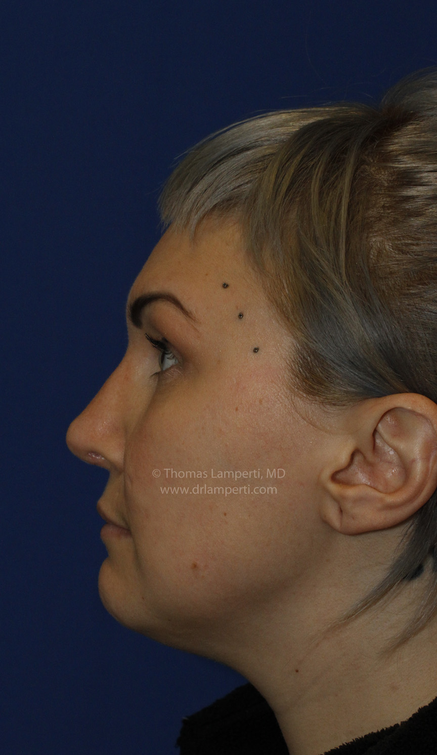 Rhinoplasty After L Profile