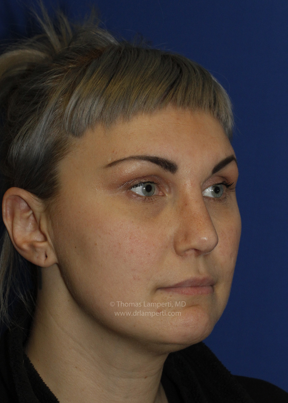 Rhinoplasty After R Oblique