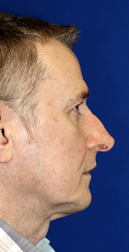 Revision rhinoplasty Before Profile
