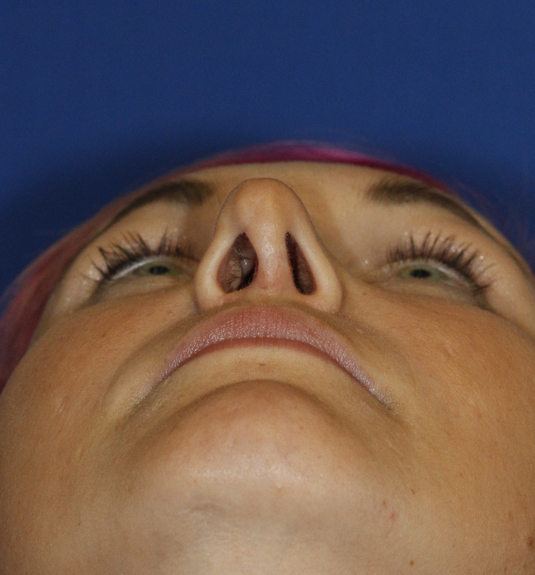 Rhinoplasty Before Base