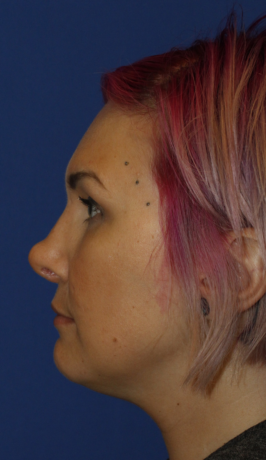 Rhinoplasty Before L Profile