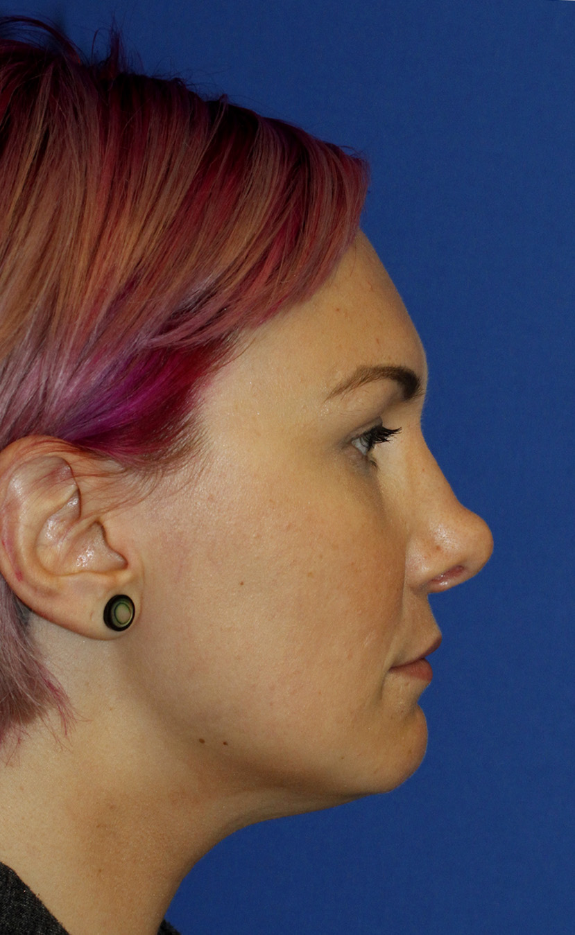 Rhinoplasty Before R Profile