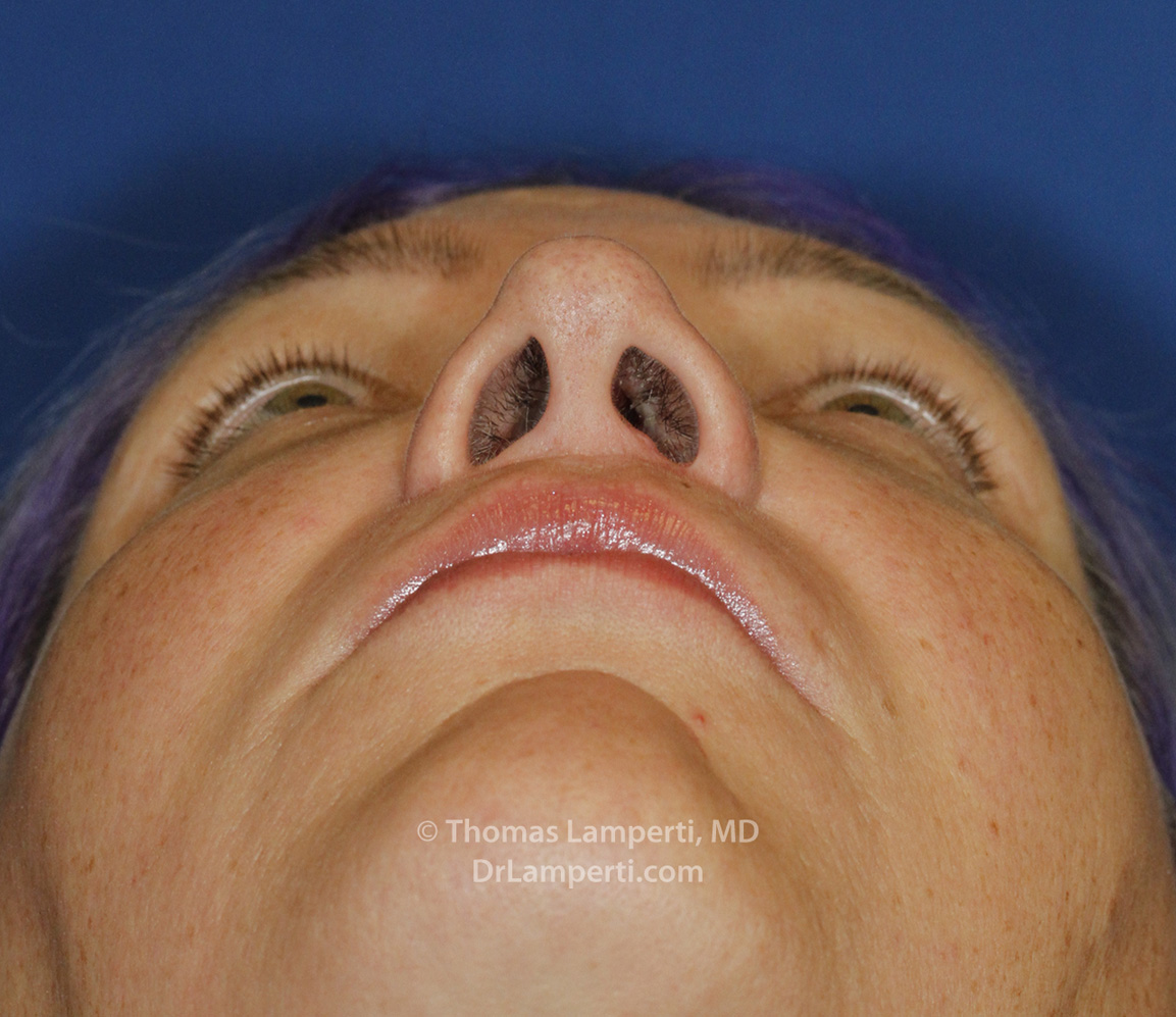 Rhinoplasty After Base