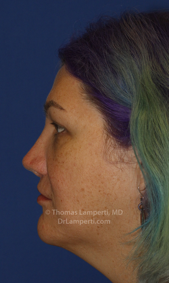 Rhinoplasty After L Profile