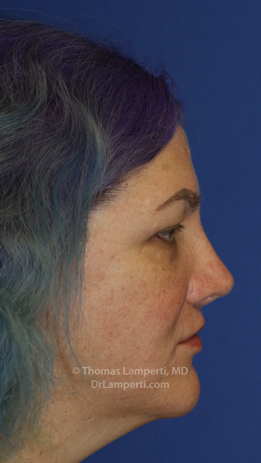 Rhinoplasty After R Profile