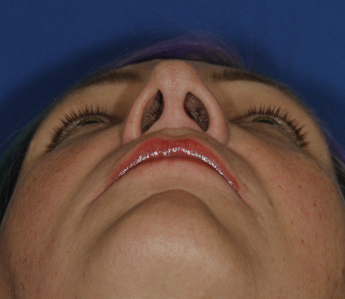 Rhinoplasty Before Base