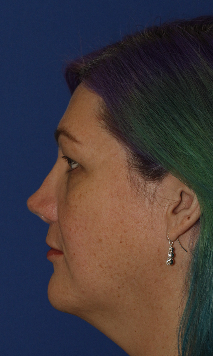 Rhinoplasty Before L Profile