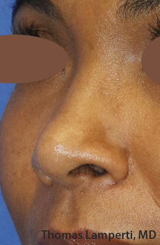 After Dominican Rhinoplasty Oblique