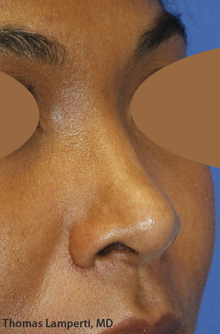 After Dominican Rhinoplasty Oblique