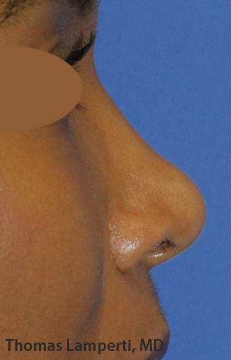 After Dominican Rhinoplasty Profile