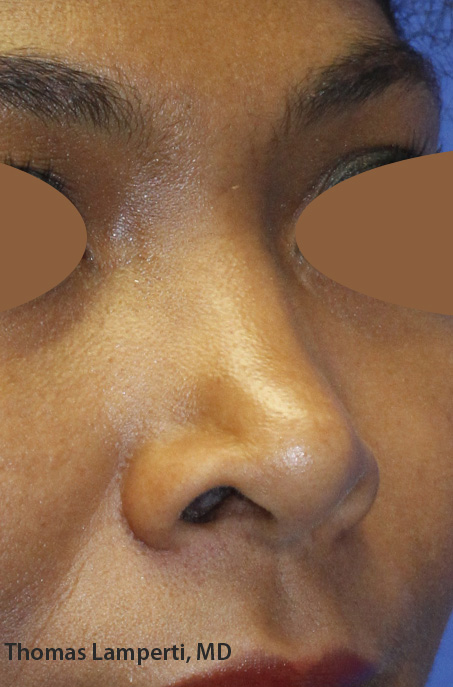 Before Dominican Rhinoplasty Oblique