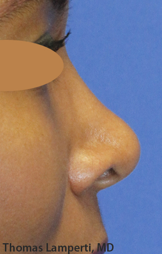 Before Dominican Rhinoplasty Profile