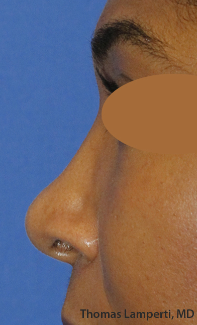 After Dominican Rhinoplasty Profile