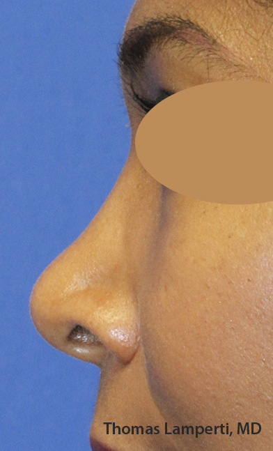 Before Dominican Rhinoplasty Profile