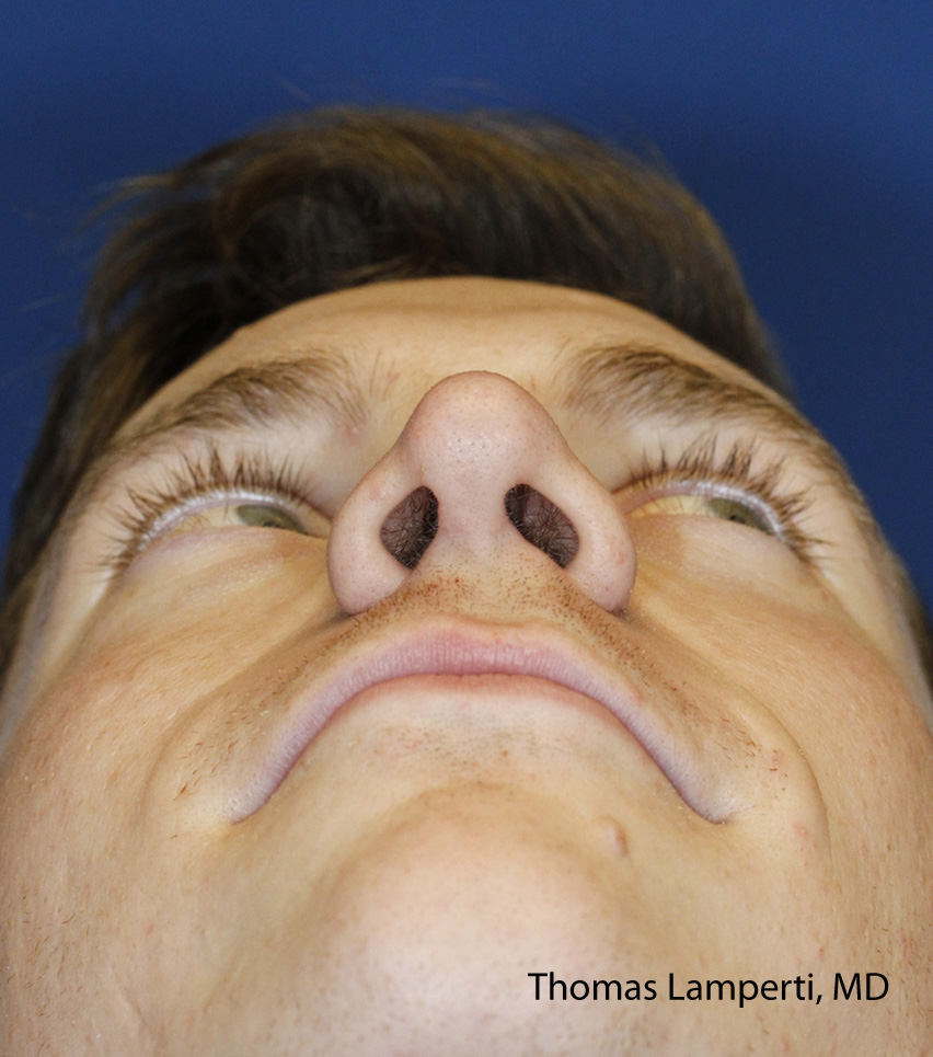 Rhinoplasty After Base