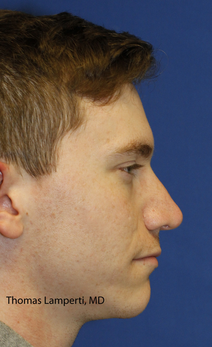Rhinoplasty After Right Profile