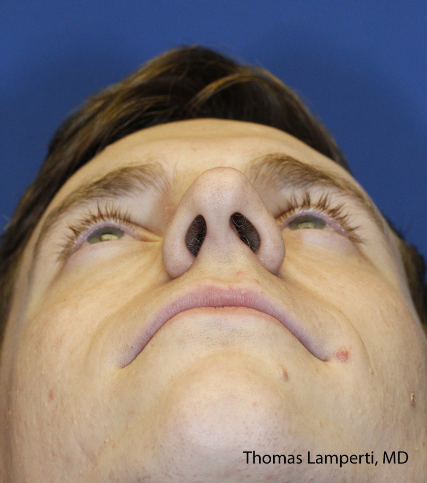 Rhinoplasty Before Base