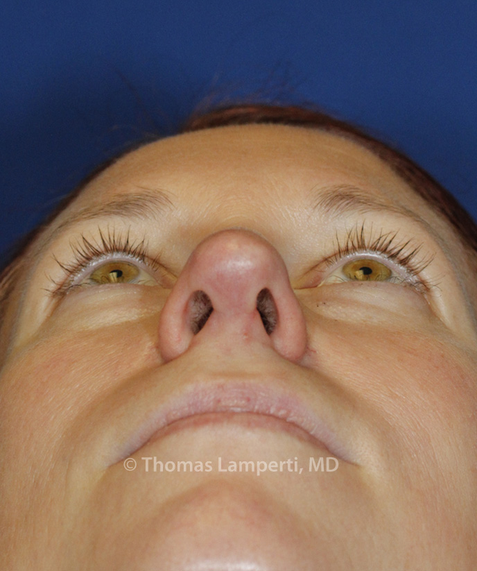 After Rhinoplasty Base