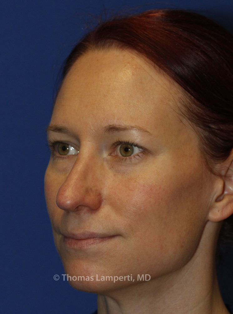 After Rhinoplasty L Oblique