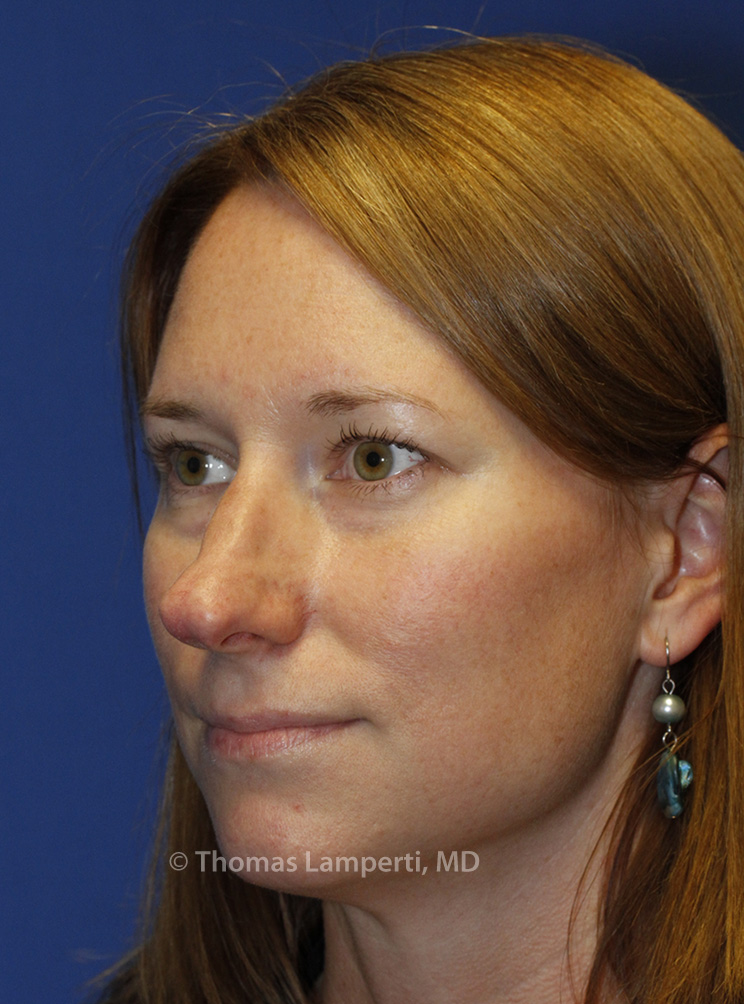 Before Rhinoplasty L Oblique