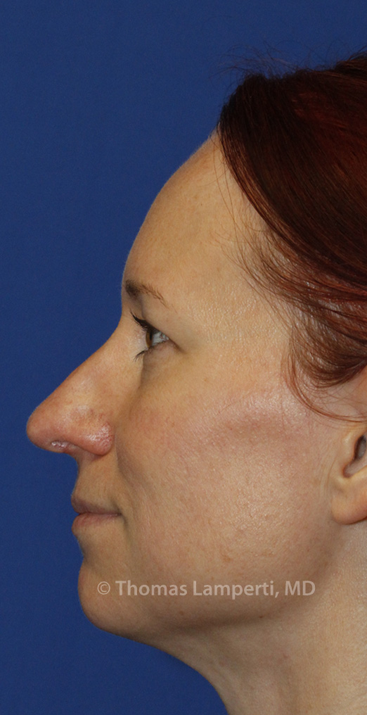 After Rhinoplasty L Profile