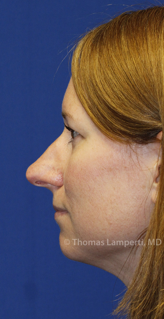 Before Rhinoplasty L Profile