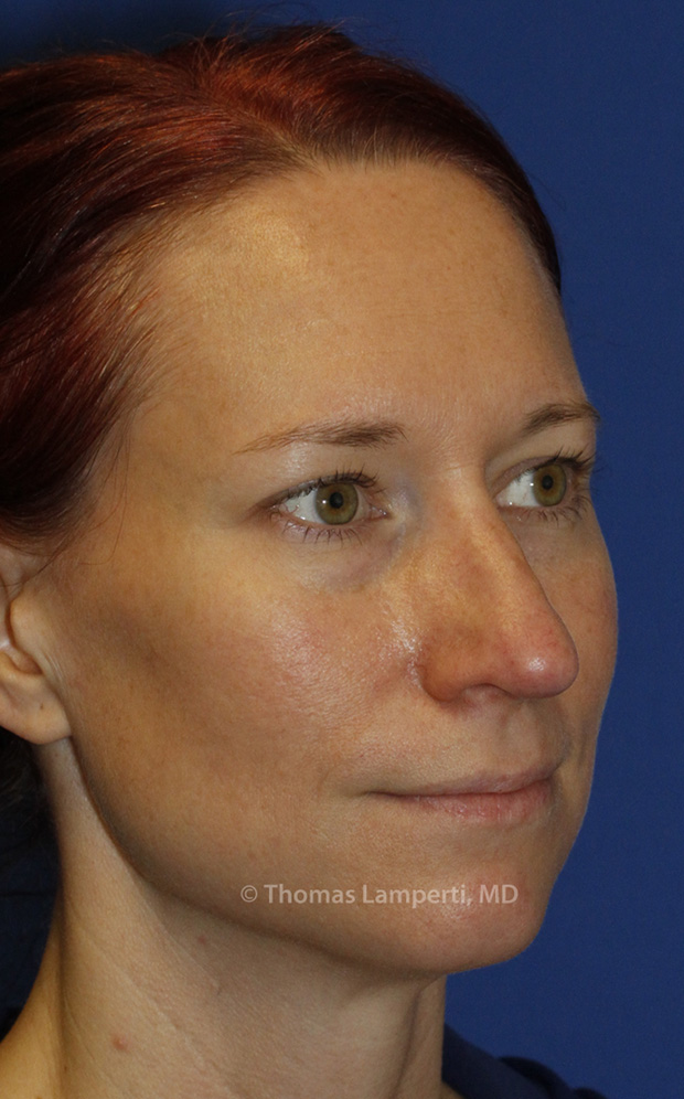 After Rhinoplasty R Oblique