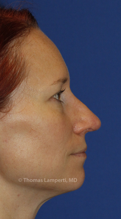 After Rhinoplasty R Profile