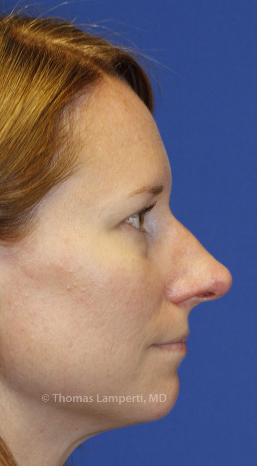 Before Rhinoplasty R Profile