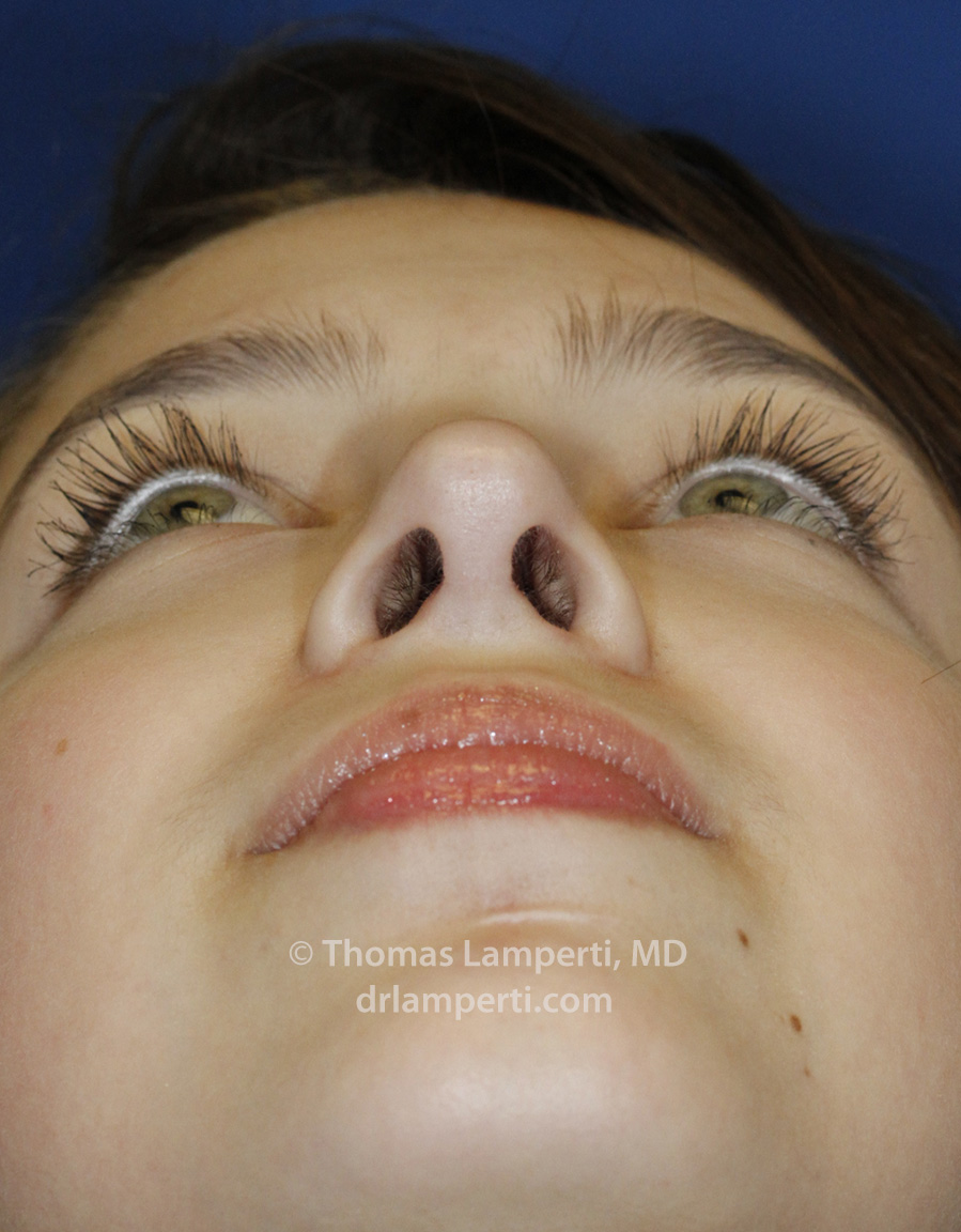 Rhinoplasty After Base