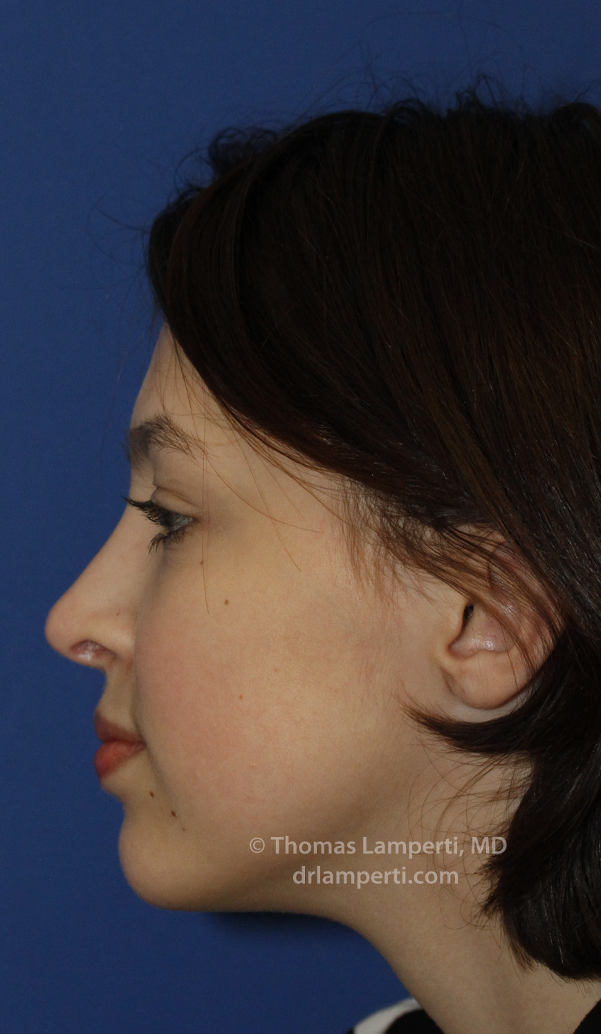 Rhinoplasty After L Profile