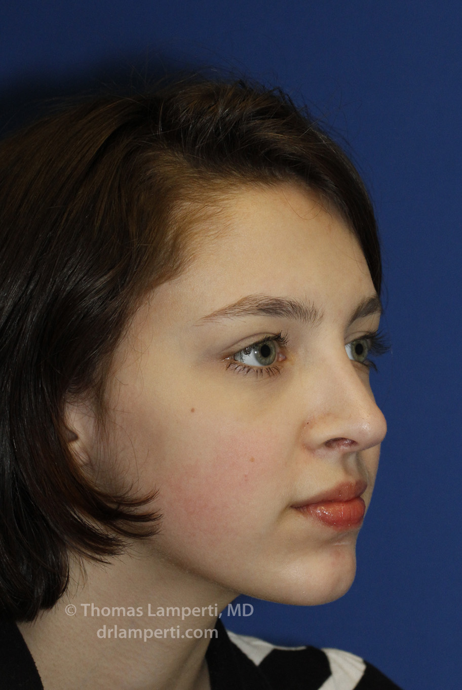 Rhinoplasty After R Oblique